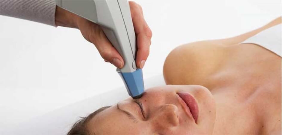 Exilis Elite, radiofréquence monopolaire de dernière génération couplée à des ultrasons défocalisés.