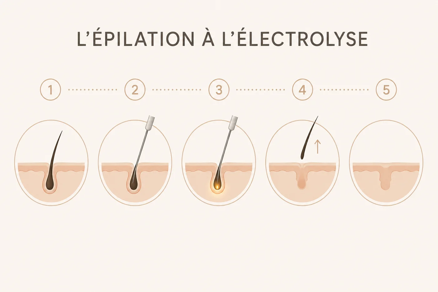 Schéma du fonctionnement de l’épilation à l’électrolyse