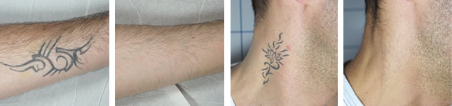 Détatouage Laser Picoseconde