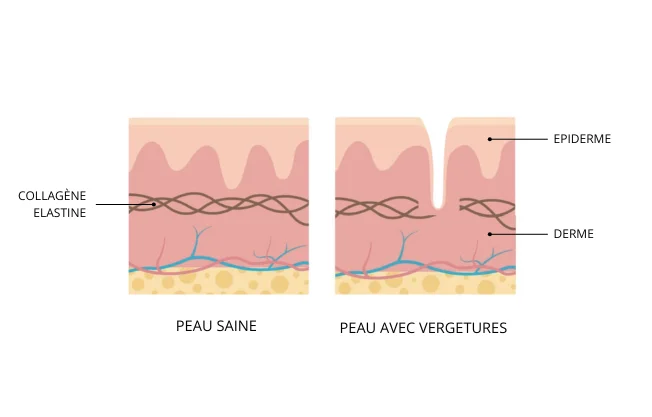 Les vergétures, c'est quoi ?